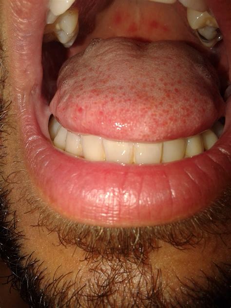 puntos rojos en la lengua